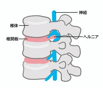 椎間板ヘルニアの部位
